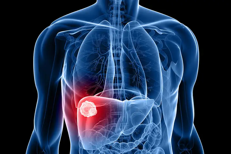 Liver Cancer Treatment in Hyderabad